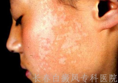面部白癜风治疗的一些常识
