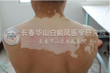 白癜风病情稳定了还需要吃药治疗吗 白癜风病情稳定了还需要吃药治疗吗