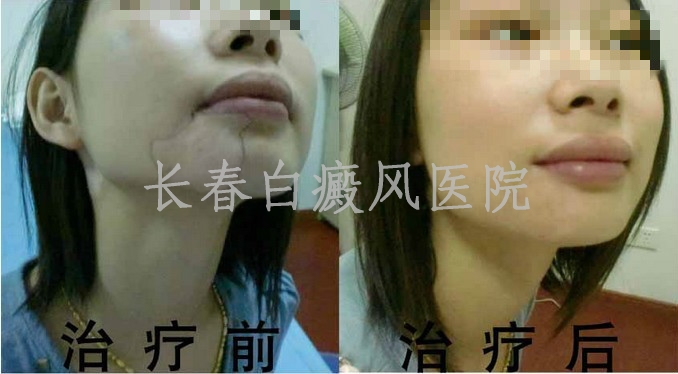 白癜风可以治好吗