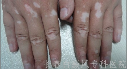 白癜风的治疗过程是怎样的 白癜风的治疗过程是怎样的