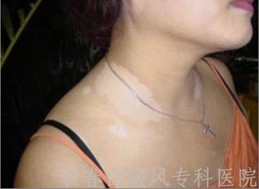 白癜风能不能治好 白癜风能不能治好