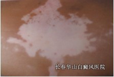 导致白癜风扩散的原因 导致白癜风扩散的原因