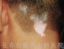 白癜风怎样正确治疗 白癜风怎样正确治疗