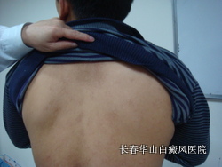 得了白癜风应该怎么治 得了白癜风应该怎么治