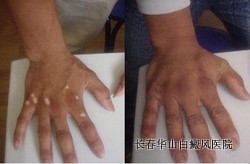 怎样可以治愈白癜风 怎样可以治愈白癜风