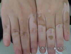 为什么会患上白癜风 为什么会患上白癜风