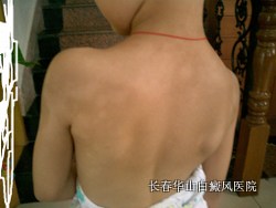 初期白癜风有什么症状 初期白癜风有什么症状