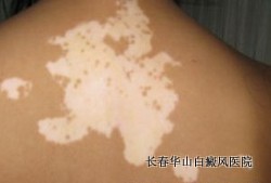 常见的白癜风病因有哪些 常见的白癜风病因有哪些