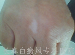 手部易出现白癜风的原因 手部易出现白癜风的原因