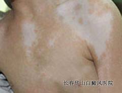 白癜风的高发原因 白癜风的高发原因