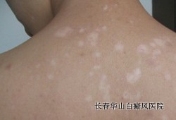 白癜风早期怎么治疗 白癜风早期怎么治疗