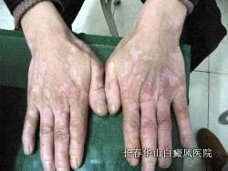 白癜风怎么治疗能早点好 白癜风怎么治疗能早点好