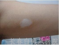 患上白癜风怎么治疗好 患上白癜风怎么治疗好