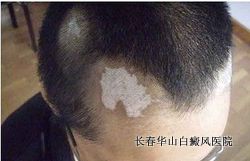 患了白癜风怎么办 患了白癜风怎么办