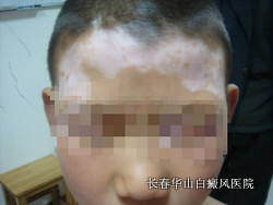 怎么做好白癜风的防治工作 怎么做好白癜风的防治工作