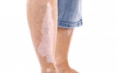 ���ϰ���Ƥ����֮����Ҫע��Է���