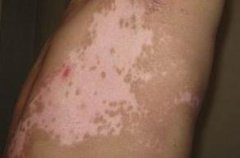 ���缲���Ļ�����ʲô��ʳϰ����Ҫע����