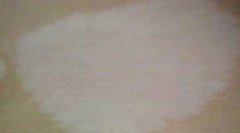 �����껼�ߵ��˰�������ʳ��Ӧע��ʲô��