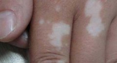 ����ĳ���֢״������Щʲô��